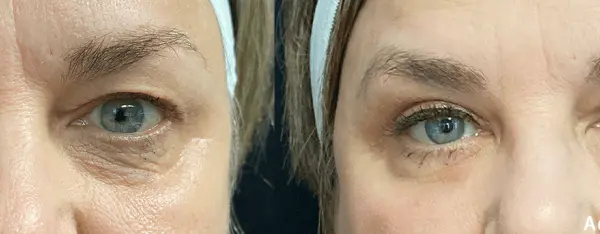 AccuTite Eyelid Before