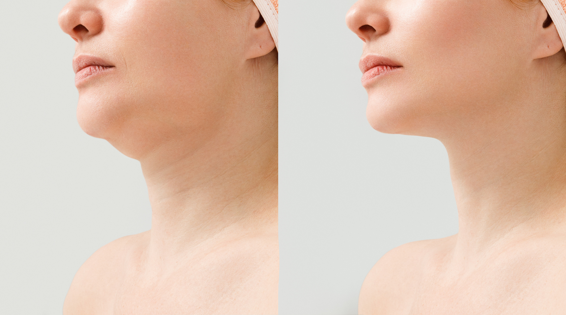QuantumRF Skin Tightening Treatment