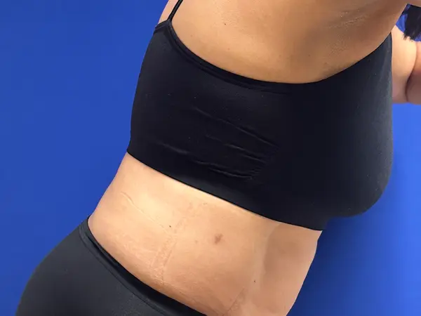 Liposuction Oblique 6 Weeks After
