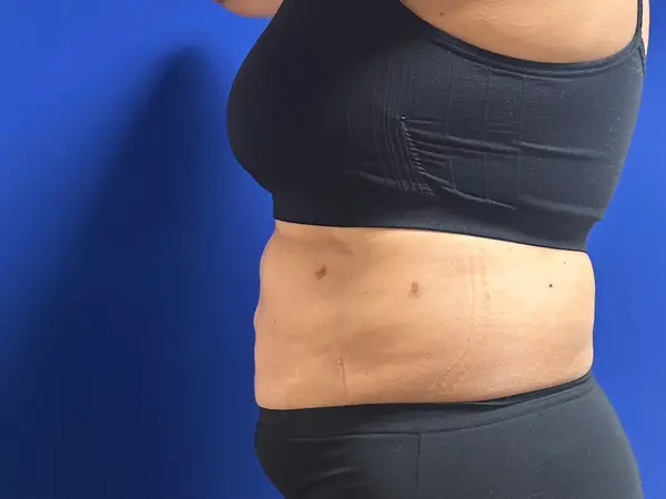 Abdomen Liposuction 6 Weeks After
