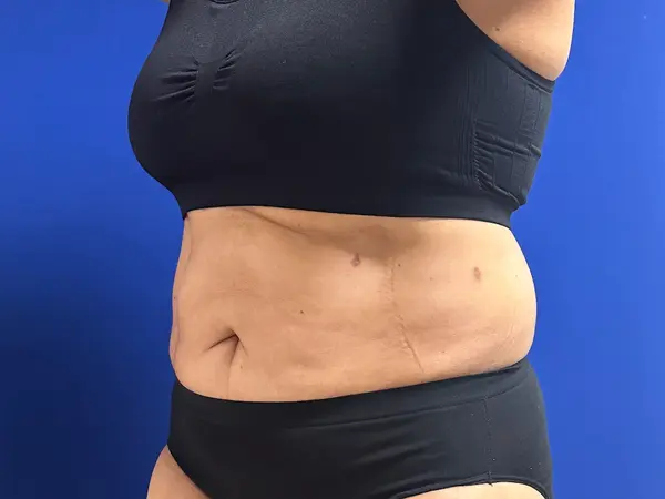 Liposuction Profile 6 Weeks After