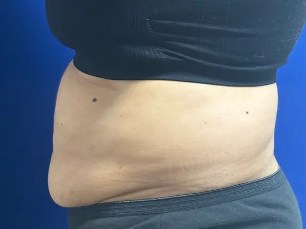 Abdomen Liposuction Before
