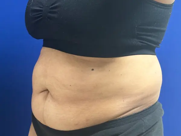 Liposuction Profile Before