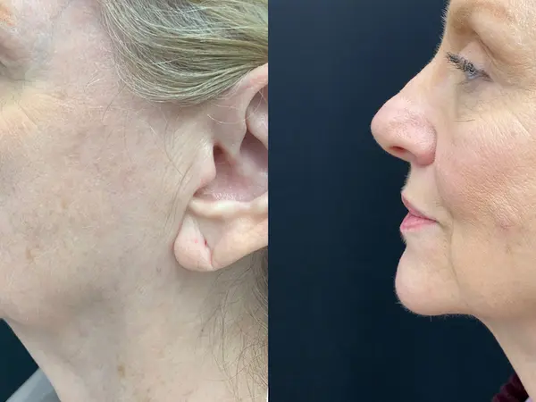 FaceTite Neck Lift Before