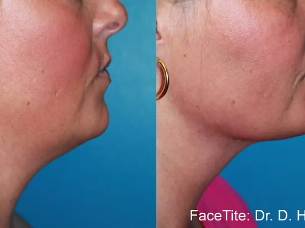 FaceTite Jawline Before